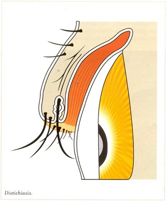 Distichiae Distichiasis – From Bunyip Farm